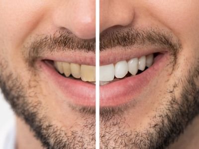 Teeth-whitening-Swastik-healthcare